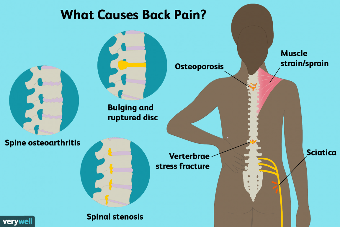 Cause Of Backpain 1152x768 