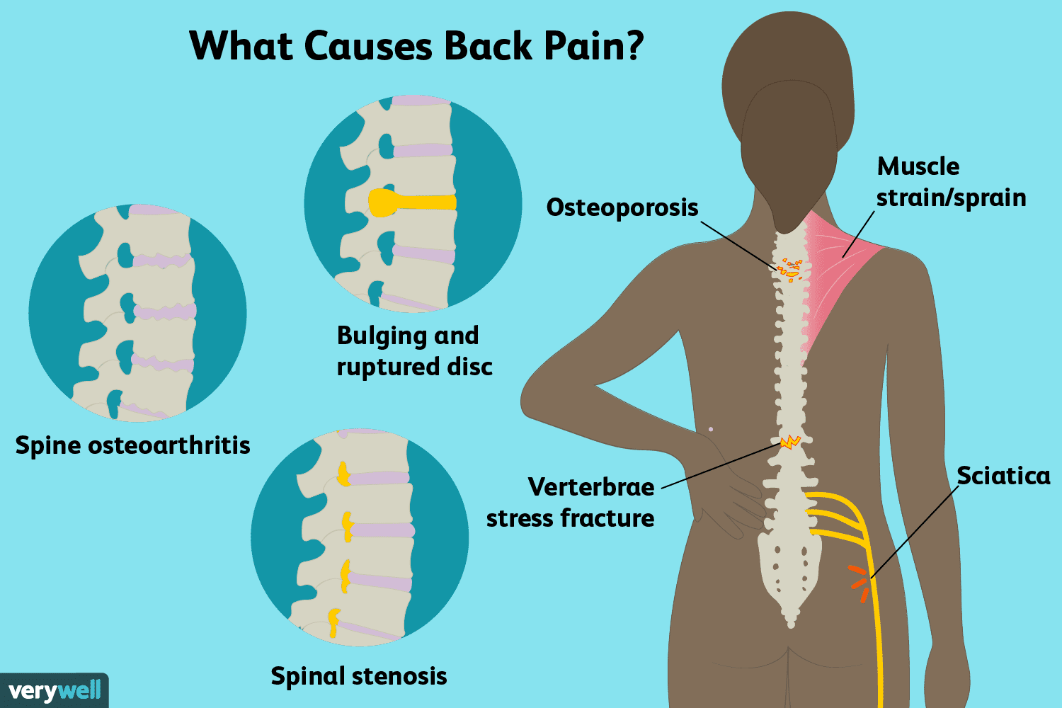 The causes of back pain