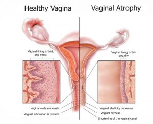 vaginal dryness in menopause